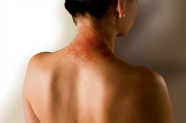 Нейродермит