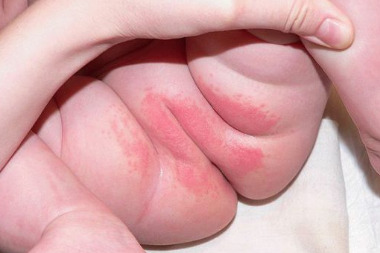 Сыпь у ребёнка