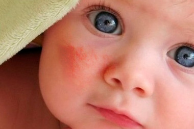 Сыпь у ребёнка1